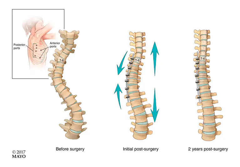 Paediatric Spinal Deformities
