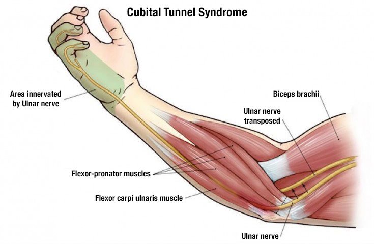 Ulnar Nerve Compression