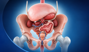 Best Uro Cancer Surgeon in Indore