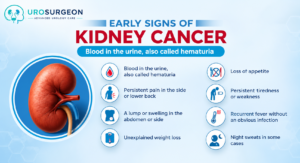 Best Uro Cancer Surgeon in Indore