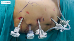 Best Uro Cancer Surgeon in Indore